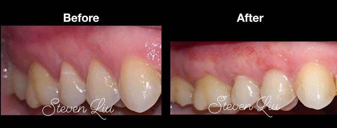 Gum Graft for Natural Teeth Case 2